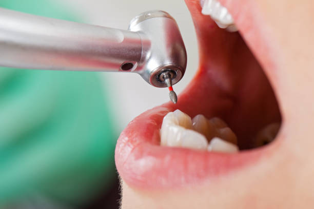 Best Broken or Chipped Tooth Repair in Georgetown, KY